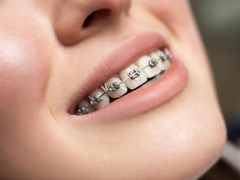 metal-braces