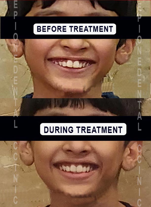 braces-treatment-in-indirapuram